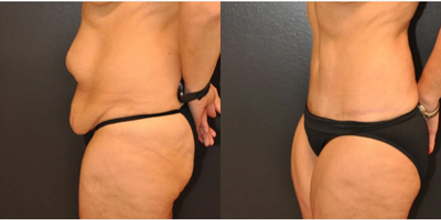 Case 1086 - Woman treated with Tummy Tuck