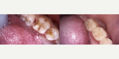Case 10862 - Patient treated with Dental Implants