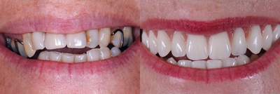 Case 10864 - 25-34 year old man treated with Dental Implants