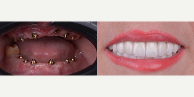 Case 10865 - 55-64 year old woman treated with All-on-4 Dental Implants, Dental Implants, Full Mouth Reconstruction, Smile Makeover, Six Mont