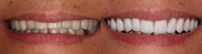 Case 10866 - 35-44 year old woman treated with Dental Implants