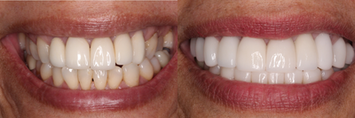 Case 10867 - 55-64 year old woman treated with Dental Implants