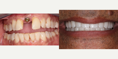 Case 10869 - 55-64 year old man treated with Dental Implants