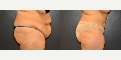 Case 1087 - Woman treated with Tummy Tuck