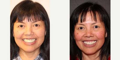 Case 10870 - 45-54 year old woman treated with Dental Implants