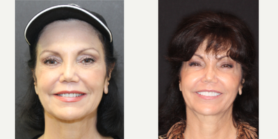 Case 10871 - 65-74 year old woman treated with Dental Implants