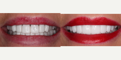 Case 10872 - 55-64 year old woman treated with Dental Implants