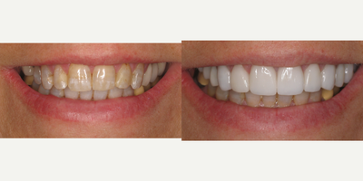 Case 10873 - 55-64 year old woman treated with Porcelain Veneers