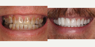 Case 10874 - 45-54 year old man treated with Dental Implants
