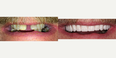 Case 10875 - 55-64 year old man treated with upper locator implant denture