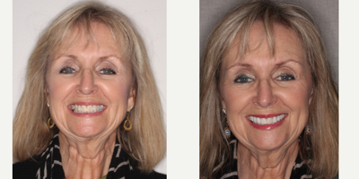 Case 10877 - 55-64 year old woman treated with Dental Implants