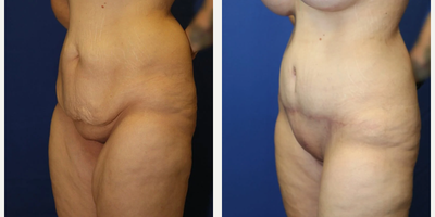 Case 1088 - Woman treated with Tummy Tuck