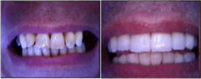 Case 10880 - Dental implants to restore bite and cosmetics