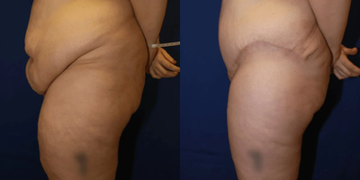 Case 1089 - Woman treated with Tummy Tuck