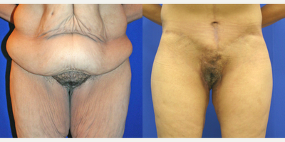 Case 109 - 55-64 year old woman treated with Tummy Tuck