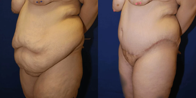 Case 1090 - Woman treated with Tummy Tuck