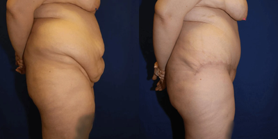 Case 1091 - Woman treated with Tummy Tuck