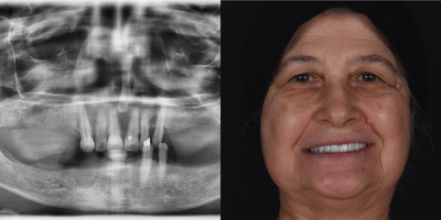 Case 10917 - 55-64 year old woman treated with All-on-4 Dental Implants, Dental Implants