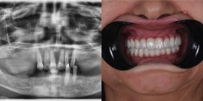Case 10918 - 55-64 year old woman treated with All-on-4 Dental Implants, Dental Implants