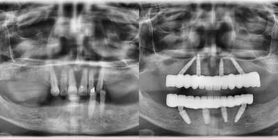 Case 10919 - 55-64 year old woman treated with All-on-4 Dental Implants, Dental Implants