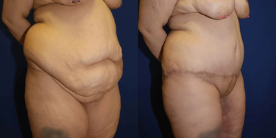Case 1092 - Woman treated with Tummy Tuck