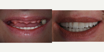 Case 10921 - 45-54 year old woman treated with All-on-4 Dental Implants, Dental Implants