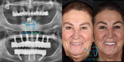 Case 10925 - 65-74 year old woman treated with All-on-4 Dental Implants, Dental Implants
