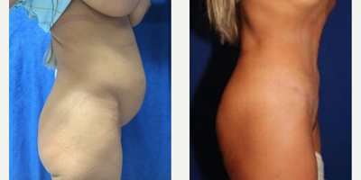 Case 1093 - Woman treated with Tummy Tuck