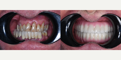 Case 10932 - 55-64 year old man treated with All-on-4 Dental Implants, Dental Implants