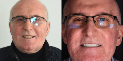 Case 10933 - 55-64 year old man treated with All-on-4 Dental Implants, Dental Implants