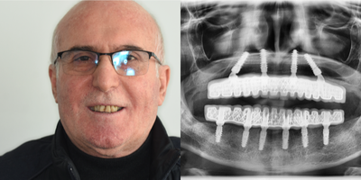 Case 10934 - 55-64 year old man treated with All-on-4 Dental Implants, Dental Implants