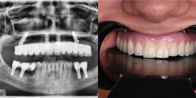 Case 10938 - 45-54 year old woman treated with All-on-4 Dental Implants, Dental Implants