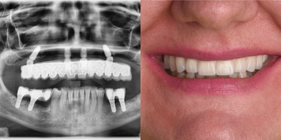 Case 10939 - 45-54 year old woman treated with All-on-4 Dental Implants, Dental Implants
