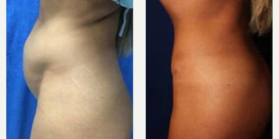 Case 1094 - Woman treated with Tummy Tuck