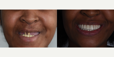 Case 10940 - 18-24 year old woman treated with All-on-4 Dental Implants, Dental Implants