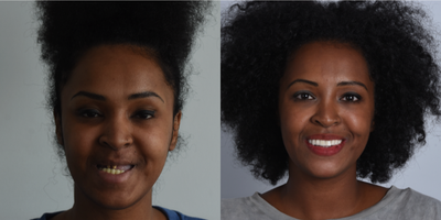 Case 10941 - 18-24 year old woman treated with All-on-4 Dental Implants, Dental Implants