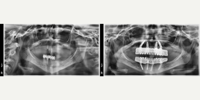 Case 10942 - 18-24 year old woman treated with All-on-4 Dental Implants, Dental Implants
