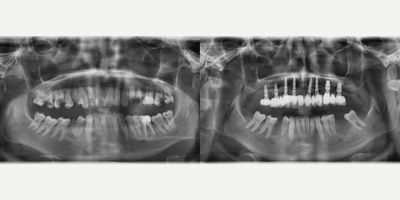 Case 10949 - 25-34 year old man treated with Dental Bone Graft, Dental Implants, Smile Makeover