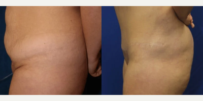 Case 1095 - Woman treated with Tummy Tuck