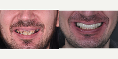 Case 10950 - 25-34 year old man treated with Dental Bone Graft, Dental Implants, Smile Makeover
