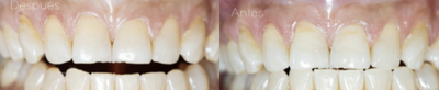Case: 10951 - before and after photo of 45-54 year old woman treated with Dental Bonding by Maritza Sarai Melendrez Flores, DDS