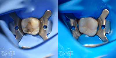 Case: 10952 - before and after photo of 18-24 year old woman treated with Dental Bonding by Maritza Sarai Melendrez Flores, DDS