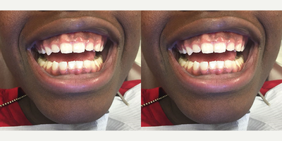 Case: 10953 - before and after photo of Laser Gum Lift for 15 year old; Immediate results by Simi Silver, DDS