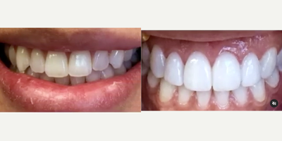 Case: 10954 - before and after photo of Woman treated with Porcelain Veneers, Teeth Whitening, Dental Bonding, Smile Makeover by Victoria Veytsman, DDS