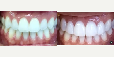 Case: 10955 - before and after photo of Woman treated with Dental Bonding, Teeth Whitening, Smile Makeover by Victoria Veytsman, DDS
