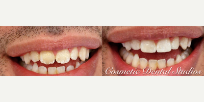 Case: 10956 - before and after photo of Man treated with Dental Bonding by Victoria Veytsman, DDS