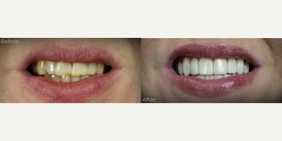 Case: 10957 - before and after photo of 35-44 year old woman treated with Dental Bonding, Smile Makeover by Erdem Ozdemir, DDS, PhD