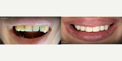 Case: 10958 - before and after photo of 25-34 year old woman treated with Dental Bonding by Erdem Ozdemir, DDS, PhD