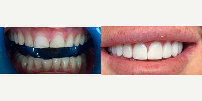 Case: 10959 - before and after photo of Georgia Kate, Composite Veneers by Erdem Ozdemir, DDS, PhD