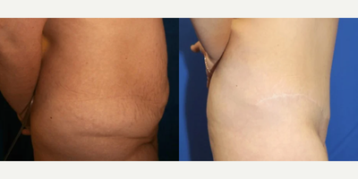 Case 1096 - Woman treated with Tummy Tuck